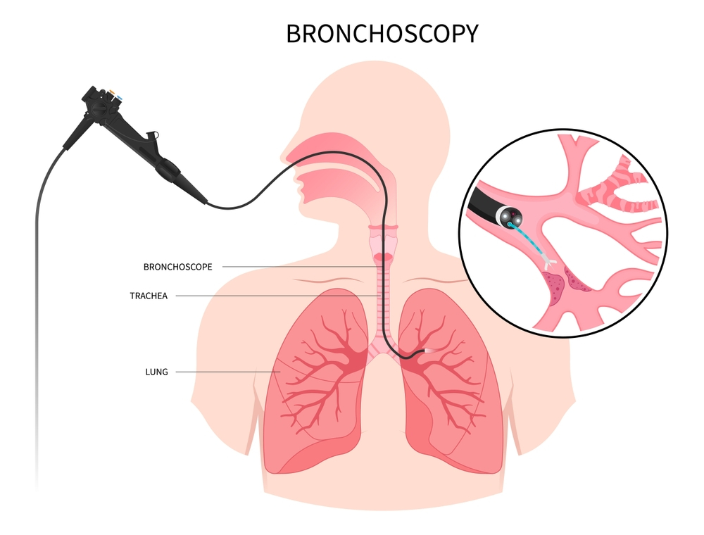 bronchoscopy treatment