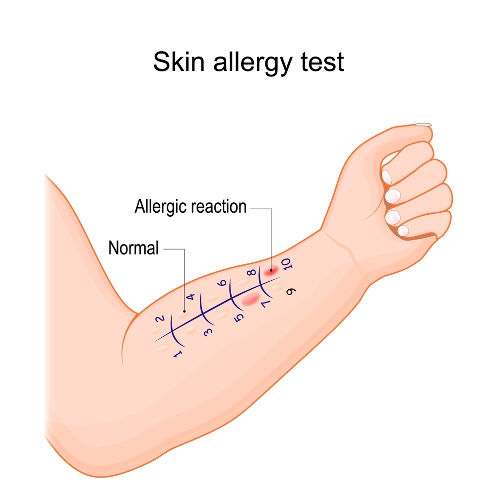 skin prick allergy test near me