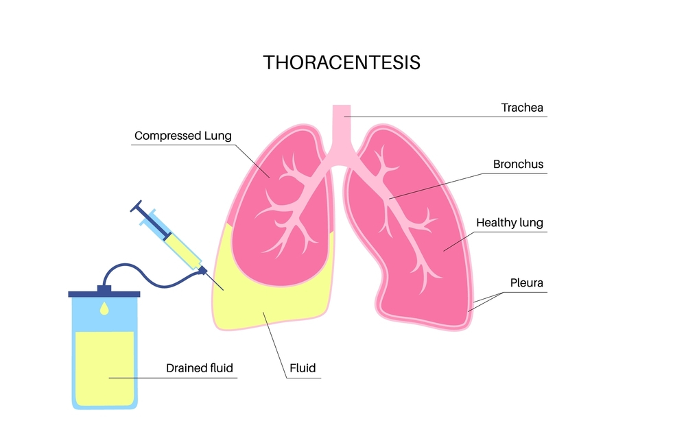 thoracentesis treatment